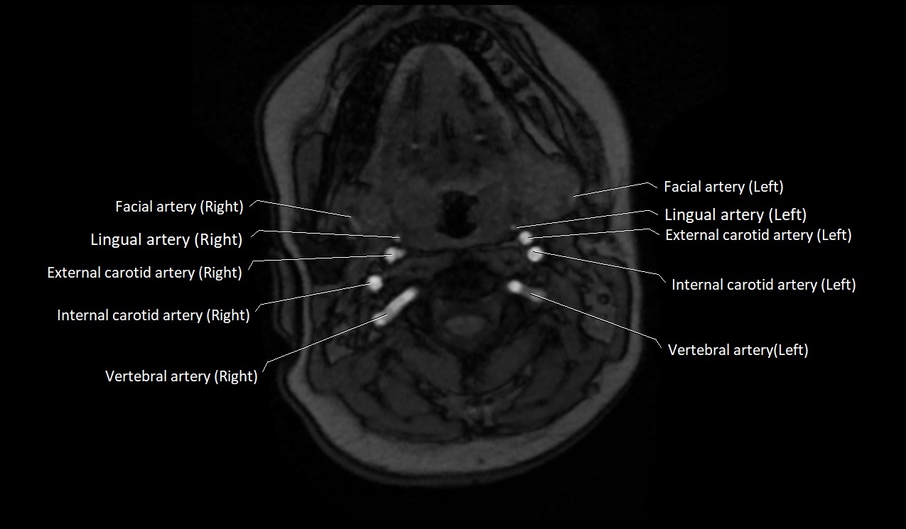 Carotid artery anatomy axial 3T image 21.jpg
